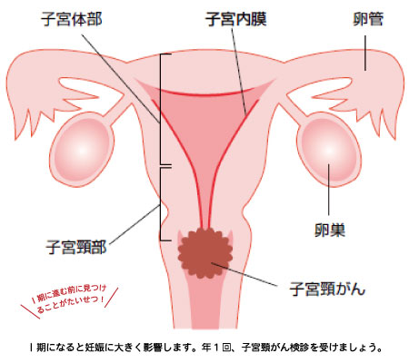 子宮頸がん イラスト画像