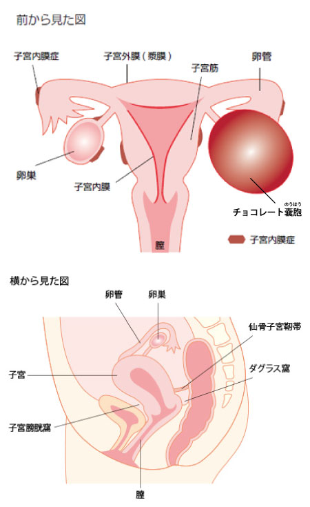 子宮内膜症 イラスト画像